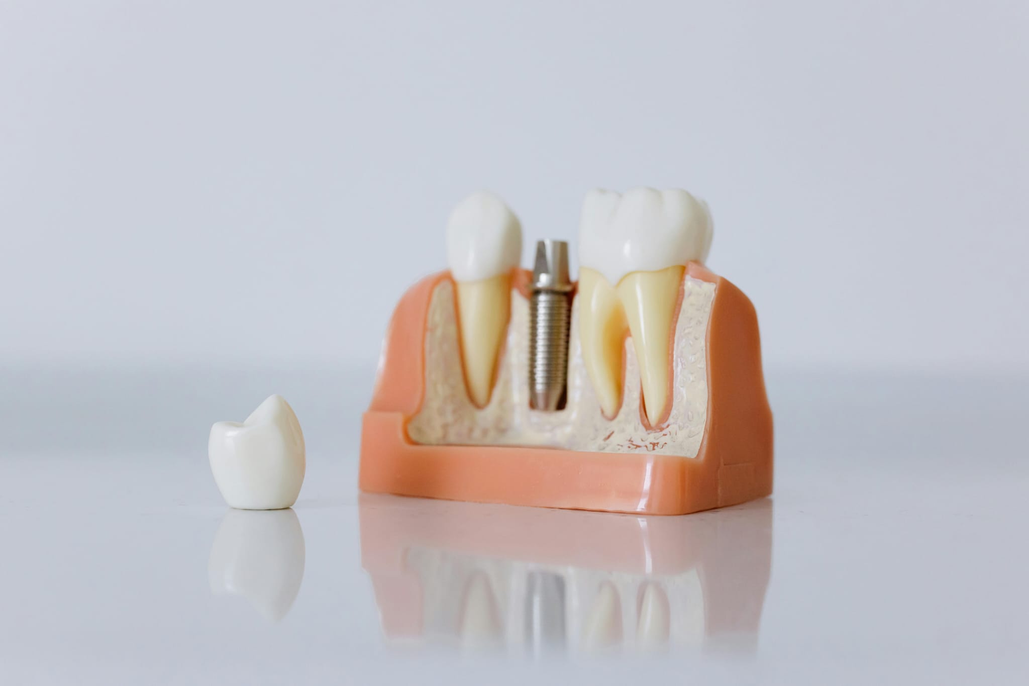 Implant Consultations & Restorations