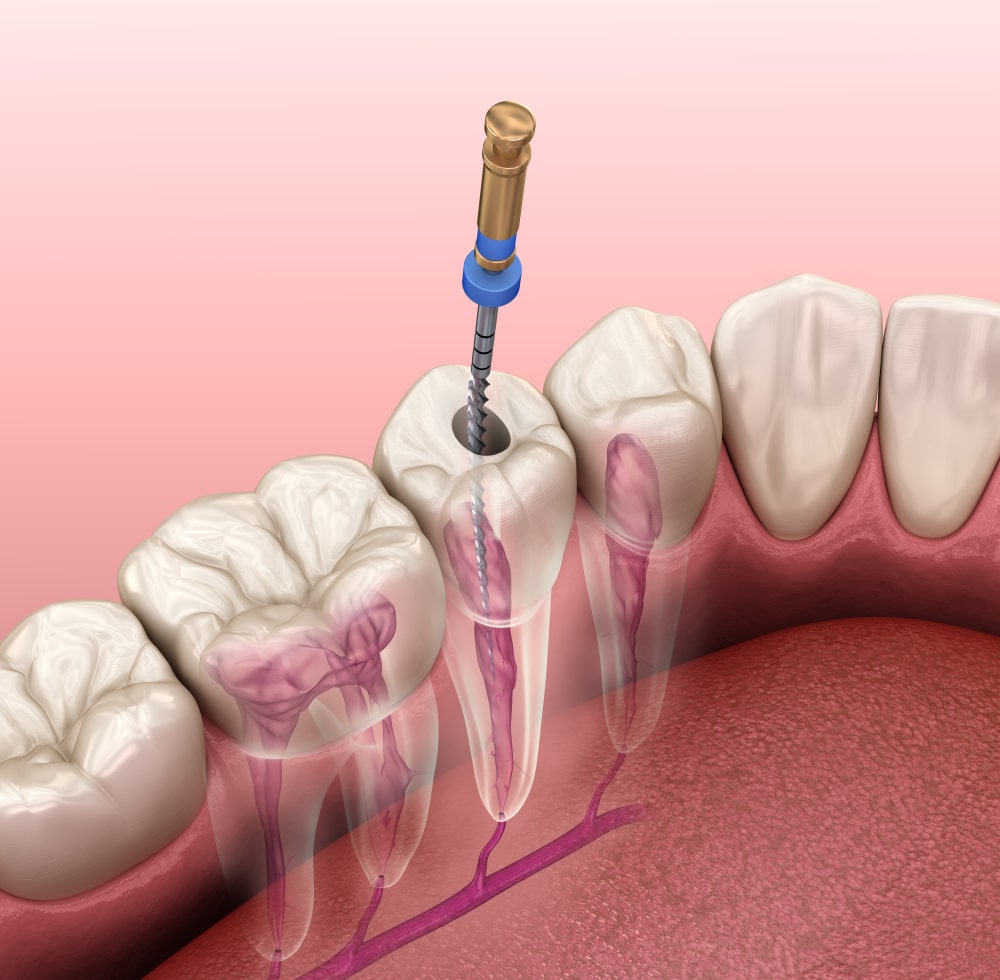 Root Canal Therapy