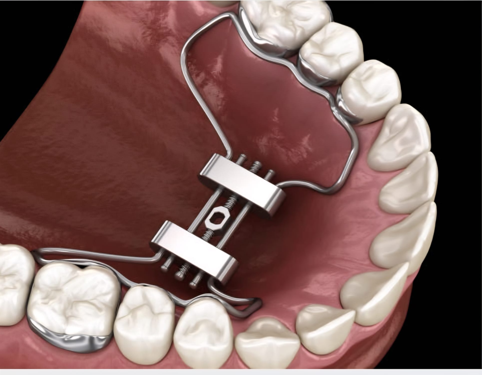 Space Maintainers & Early Orthodontics