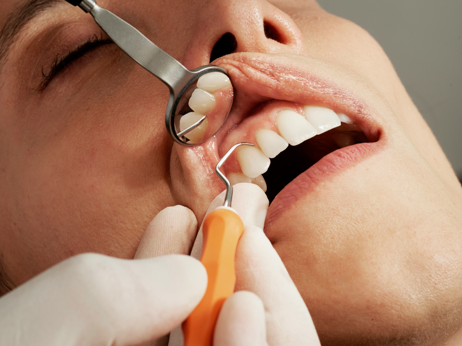 Professional Teeth Cleaning