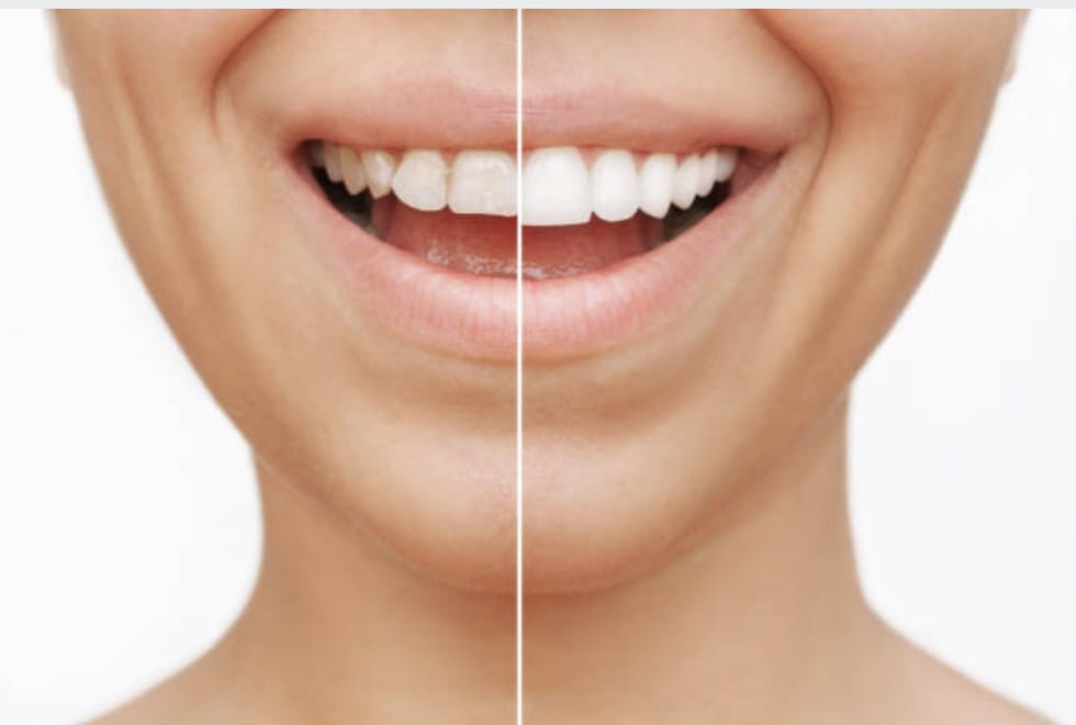 Tooth Bonding & Composite Veneers