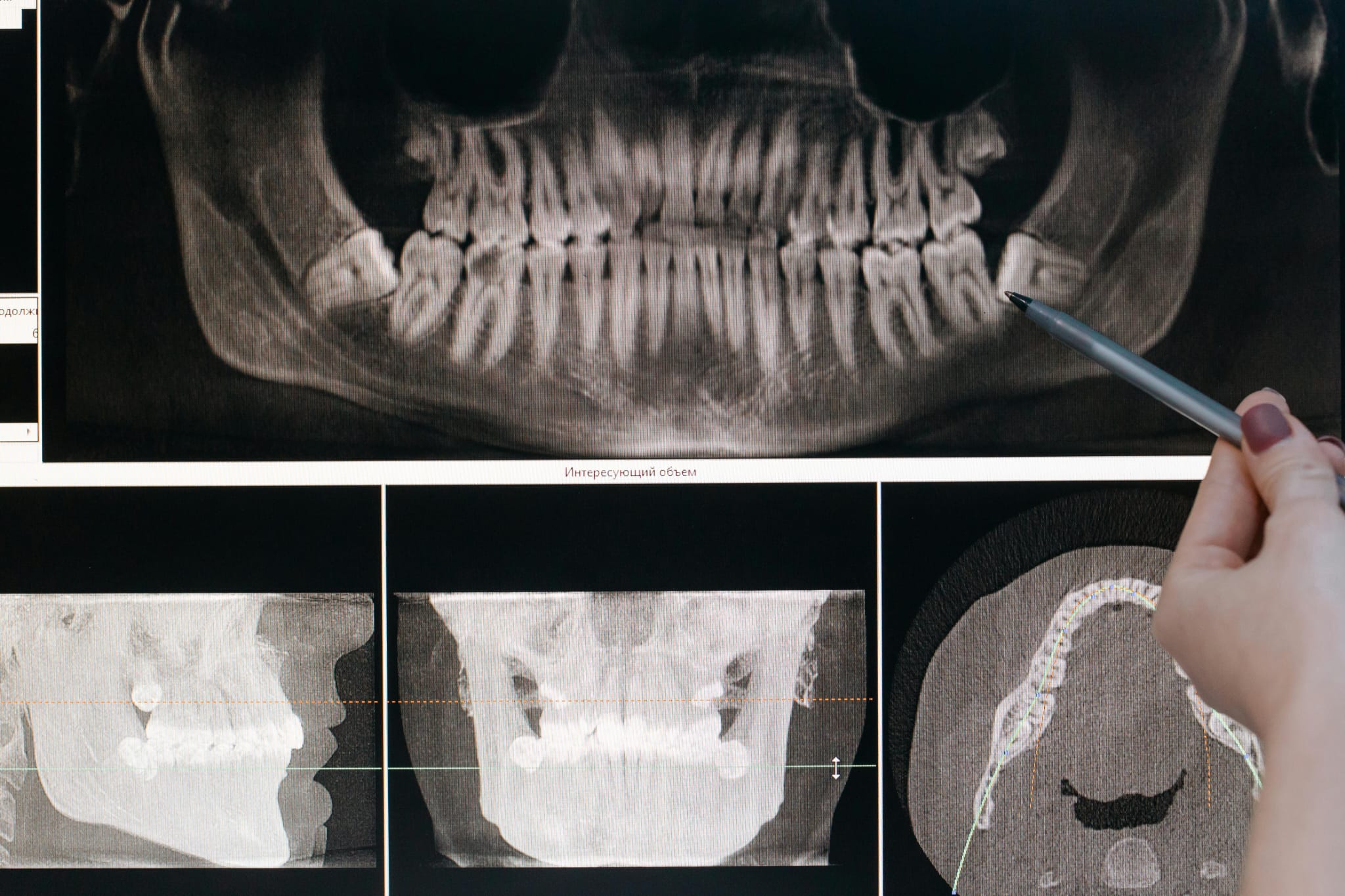 Dental Exam & Digital X-Rays